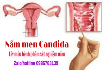 Tìm hiểu về bệnh viêm âm đạo do nấm Candida ở phụ nữ và cách điều trị