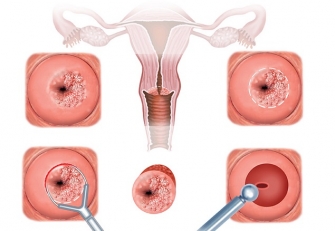 Bệnh viêm lộ tuyến cổ tử cung là gì, triệu chứng và cách trị hiệu quả