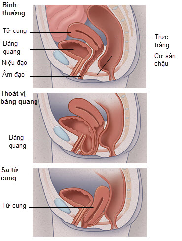 hình ảnh của bệnh sa tử cung